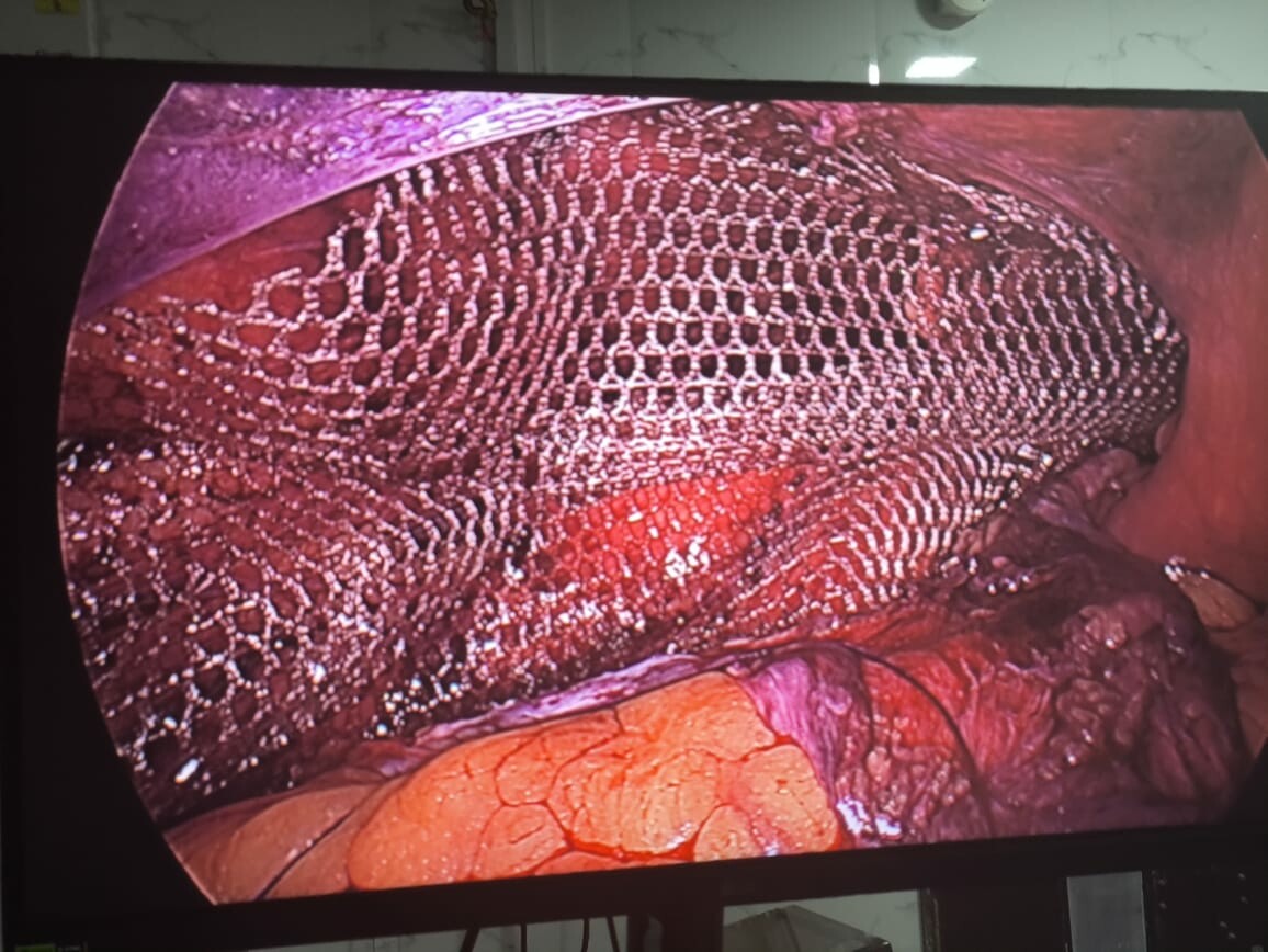 Advanced TAPP Technique for Left Inguinal Hernia Repair at Pulse Multispeciality Hospital|Pulse Multispeciality Hospital|Navale Bridge,Pune